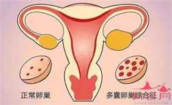长沙有供卵供精的医院吗，子宫内膜异位症——痛经的一种常见病因